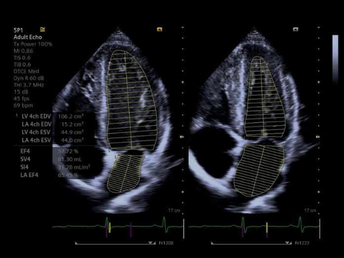 Acuson juniper Siemens Healthineers