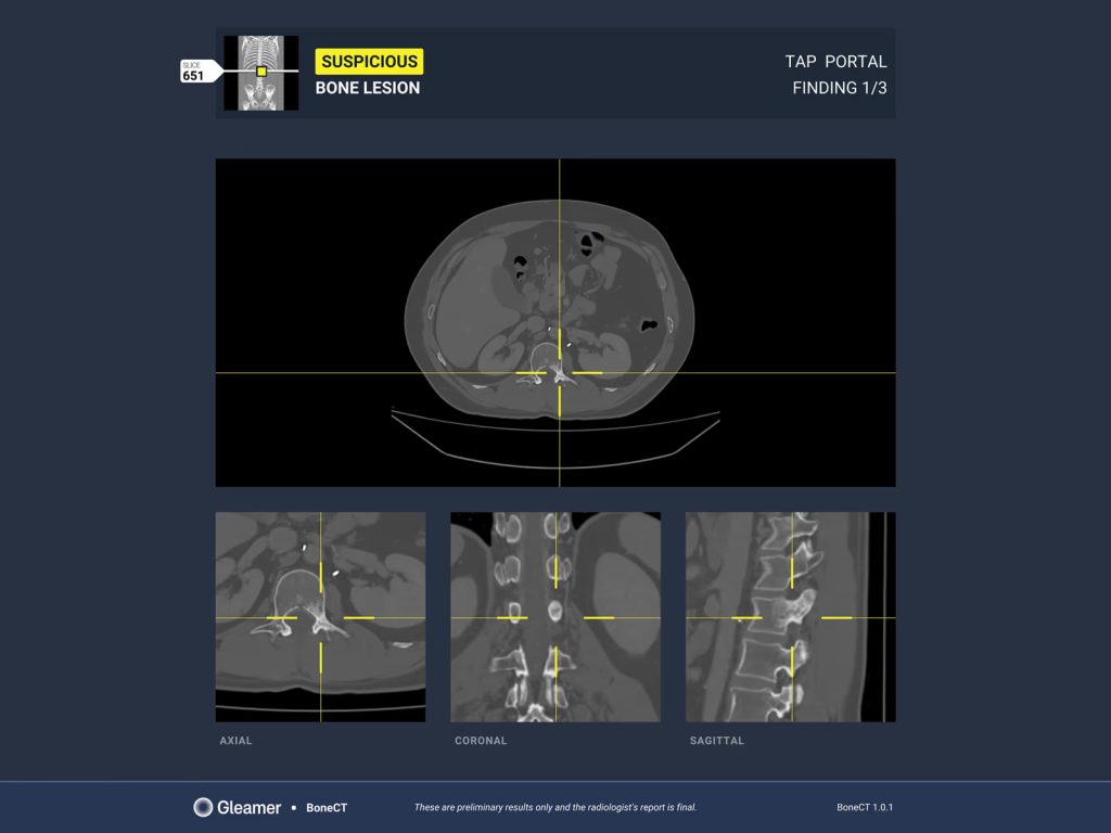 Aplicatie AI pentru detectarea leziunilor osoase secundare GleamerBoneCT