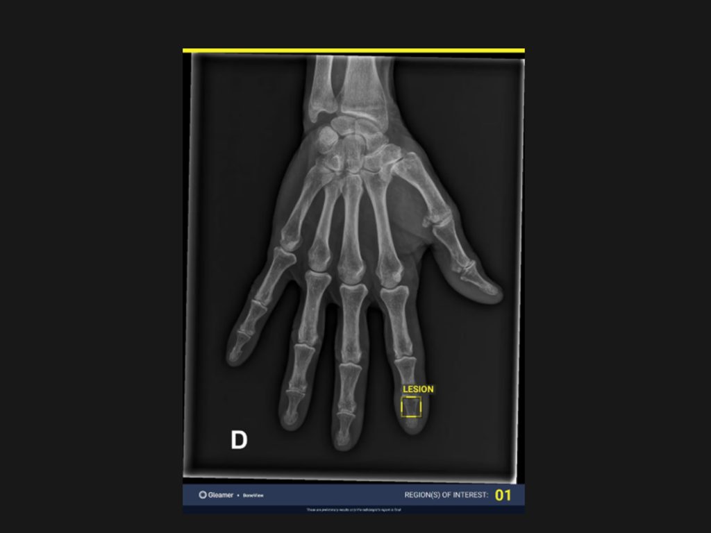 Gleamer - aplicatie de AI pentru detectia fracturilor si a leziunilor osoase