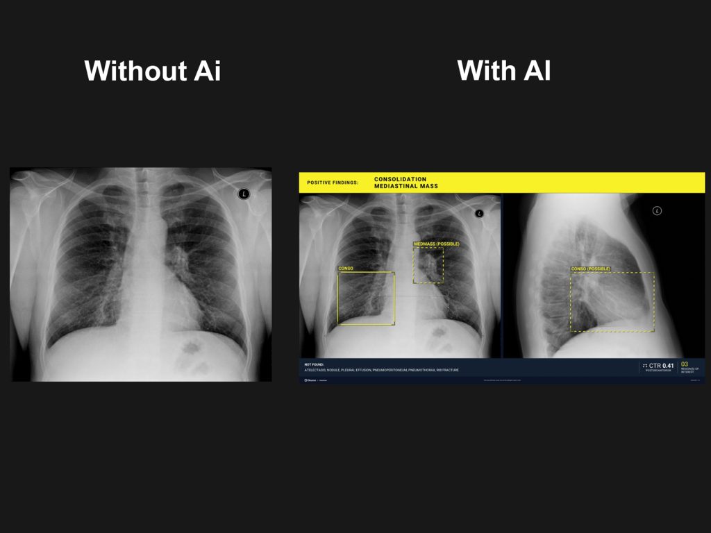 Aplicatie AI pentru detecția leziunilor toracice urgente Gleamer ChestView
