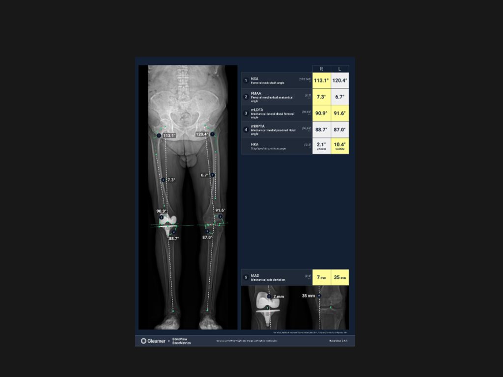 Aplicatie AI măsurătorilor musculo-scheletale (MSK)