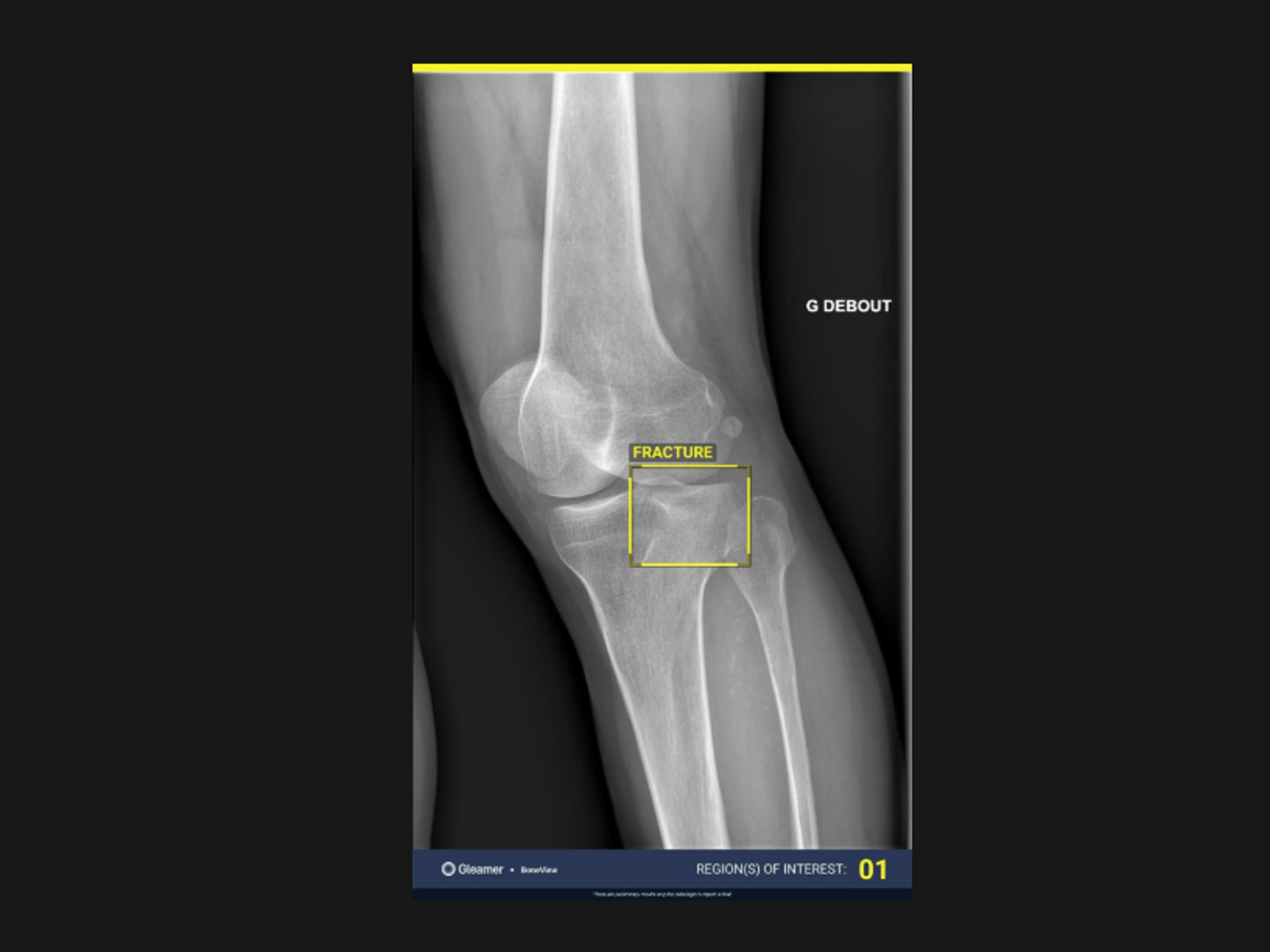 Gleamer - aplicatie de AI pentru detectia fracturilor si a leziunilor osoase