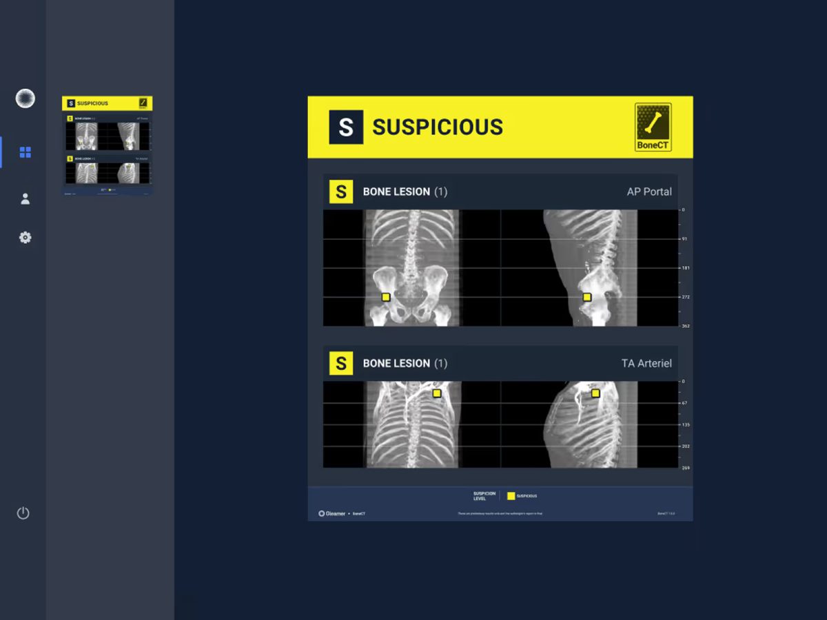 Aplicatie AI pentru detectarea leziunilor osoase secundare GleamerBoneCT