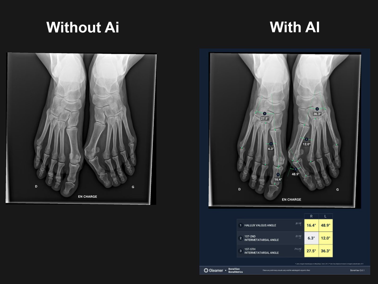 Aplicatie AI măsurătorilor musculo-scheletale (MSK)