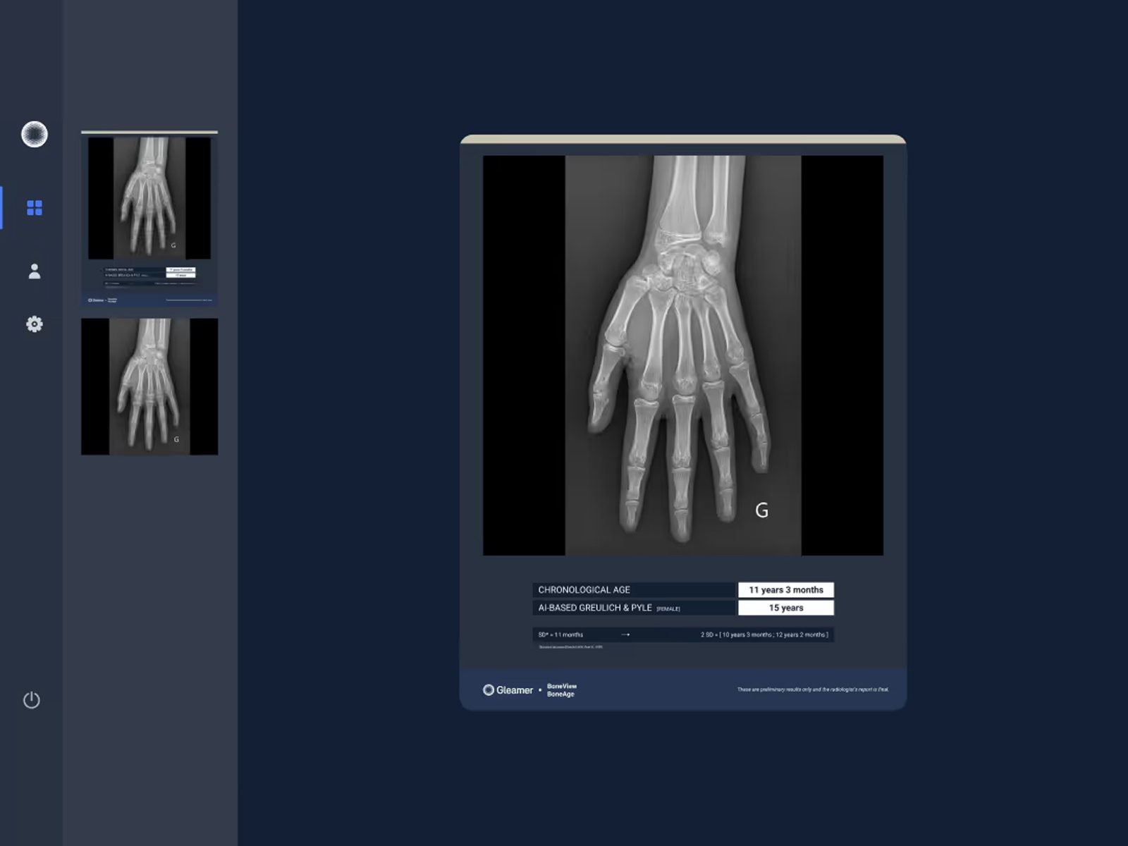 Aplicatie AI pentru evaluarea vârstei osoase - Gleamer BoneMetrics