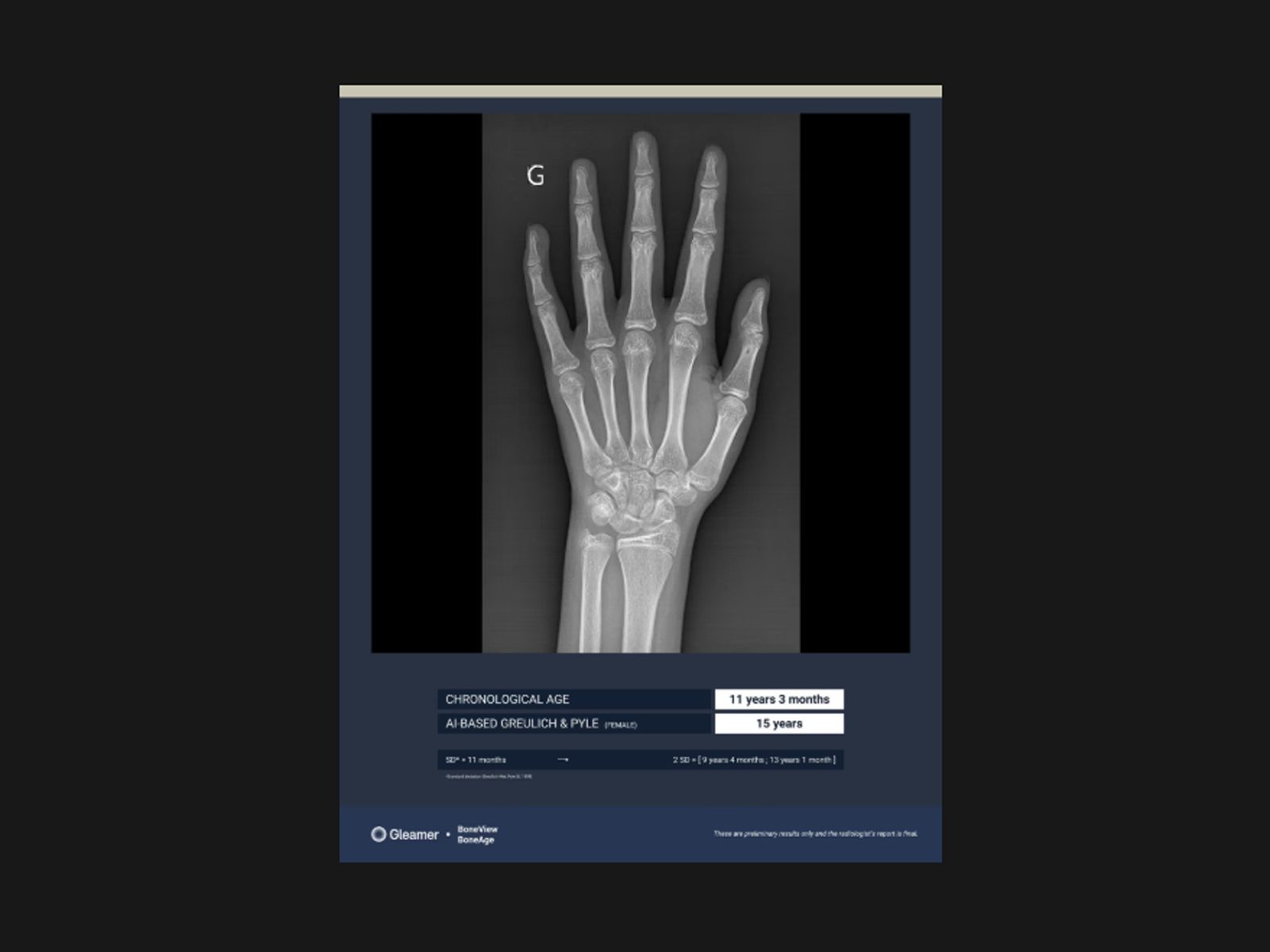 Aplicatie AI pentru evaluarea vârstei osoase - Gleamer BoneMetrics