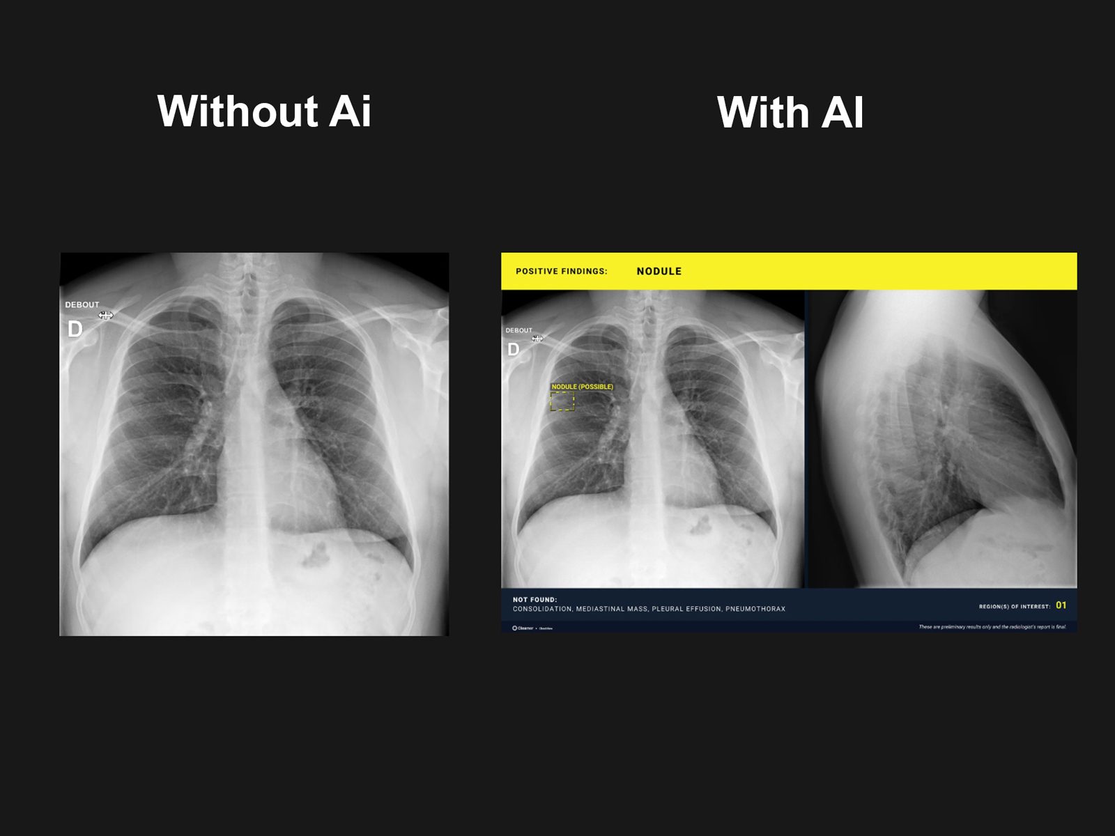 Aplicatie AI pentru detecția leziunilor toracice urgente Gleamer ChestView